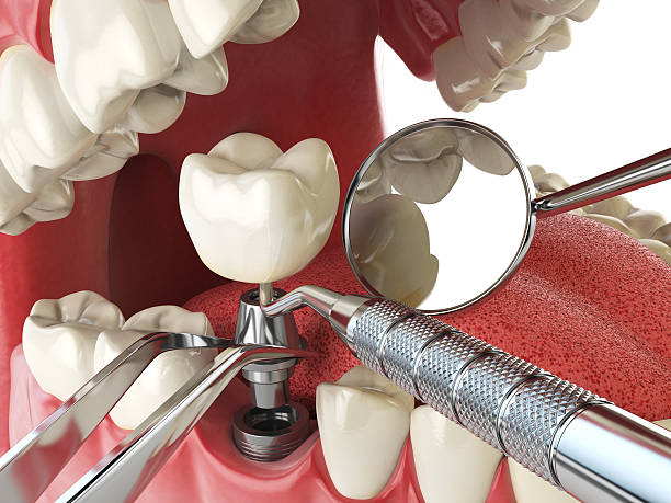 Best Lost Filling or Crown Replacement in Hamilton College, NY
